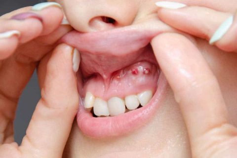 Drückt gegen zahnfleisch weisheitszahn Entzündung an
