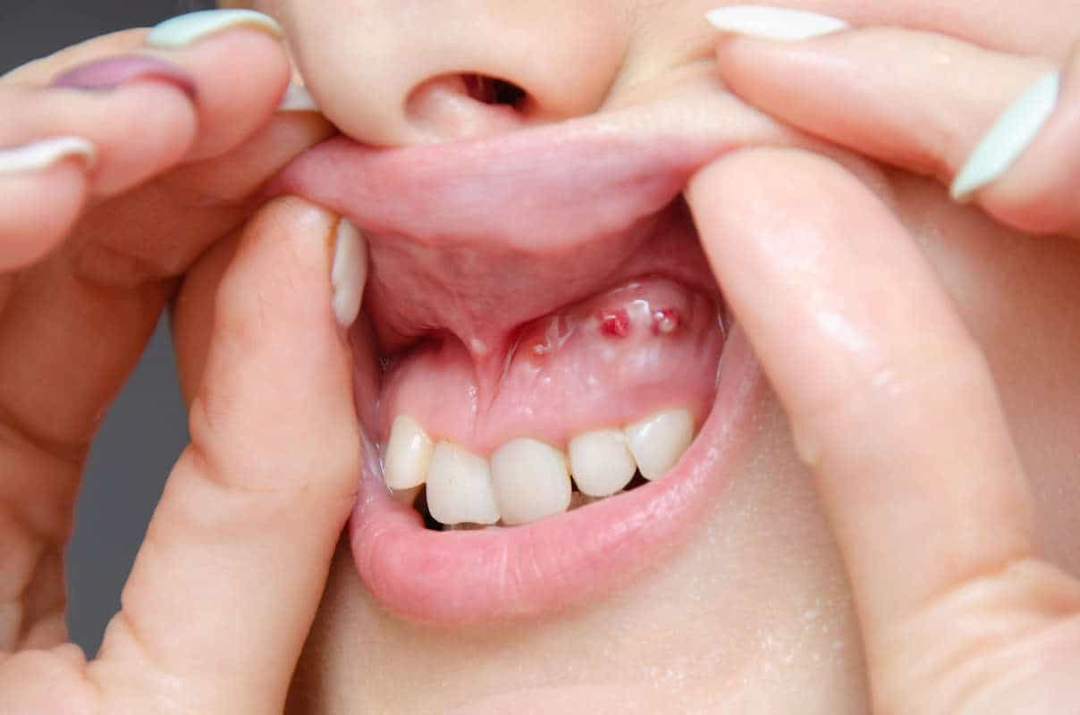 Drückt zahnfleisch weisheitszahn gegen ω Zahnfleisch