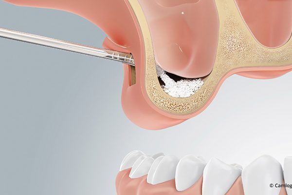 Zahnimplantat trotz Knochenschwund dank Knochenaufbau