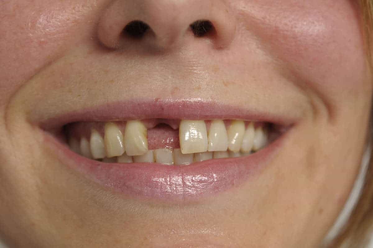 Fehlenden Zahn ersetzen durch ein Zahnimplantat in Düsseldorf