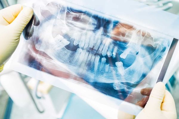 Implantat-Berater: 10teiliger Ratgeber über Zahnimplantate