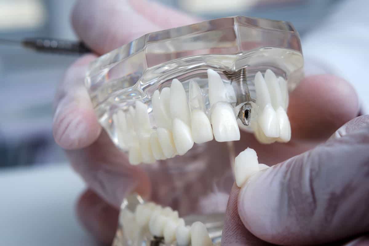 Zahnimplantat in Düsseldorf: Freilegung und prothetische Versorgung