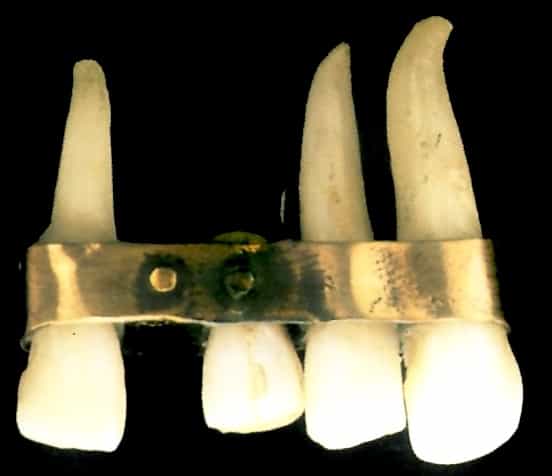 Zahnimplantat in Düsseldorf: Kurze Geschichte der Kunstzähne, z. B. der etruskische Zahnersatz
