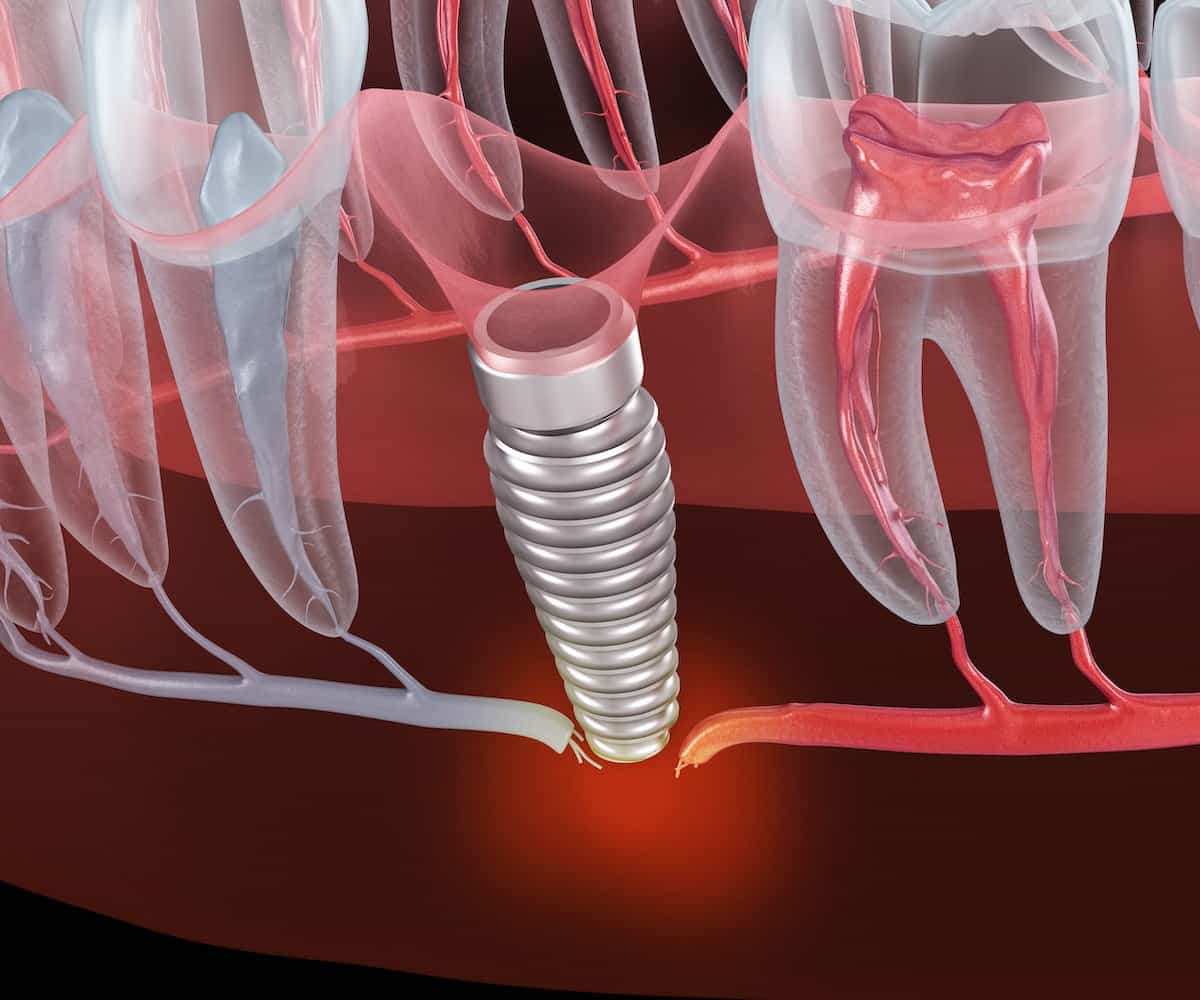 Zahnimplantat-Risiken und mögliche Komplikationen: Wenn ein Implantat zu lang ist