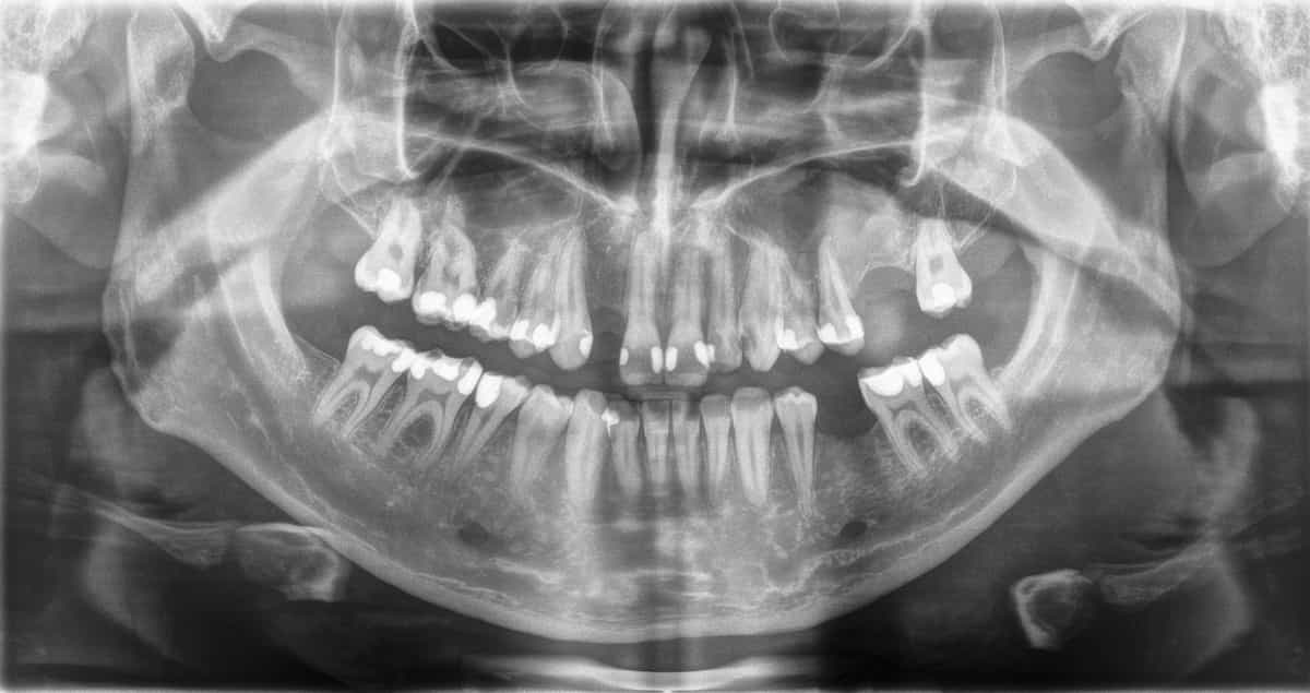 Eine Röntgenaufnahme ist Voraussetzung für ein Zahnimplantat