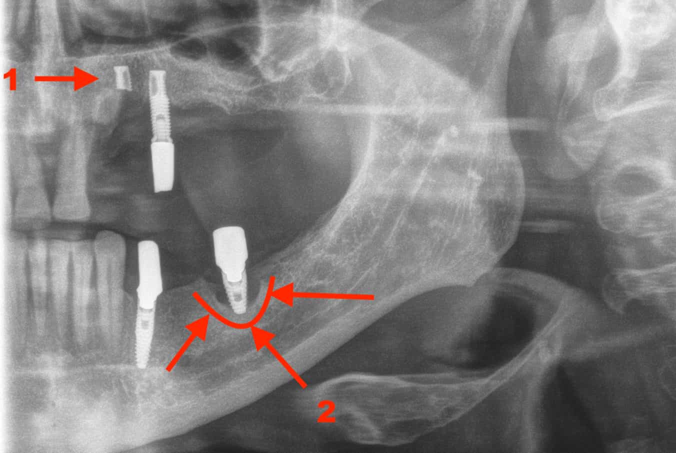 Eine Röntgenaufnahme ist Voraussetzung für ein Zahnimplantat: Hier ist ein gebrochenes Implantat zu sehen (1) sowie eine Periimplantitis (2)