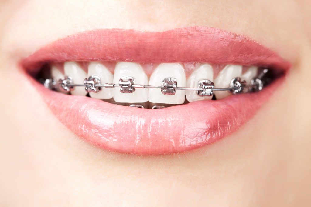 Wachstumsstörung bei Zähnen: Therapie eines ankylosierten Frontzahns nach Zahnstange